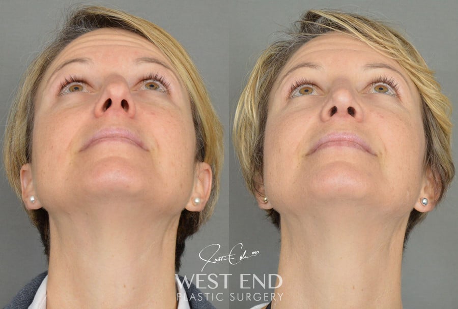 Rhinoplasty before photo. Individual results may vary.