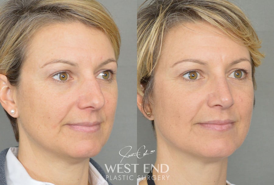 Rhinoplasty before photo. Individual results may vary.