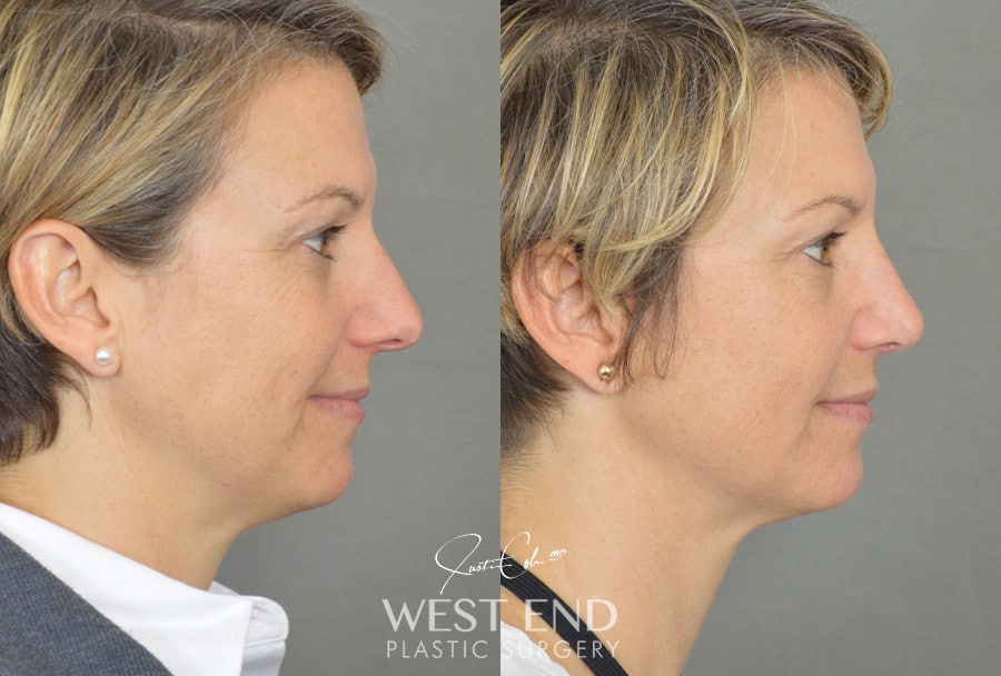 Rhinoplasty before photo. Individual results may vary.