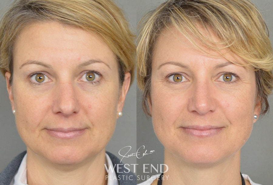 Rhinoplasty before photo. Individual results may vary.