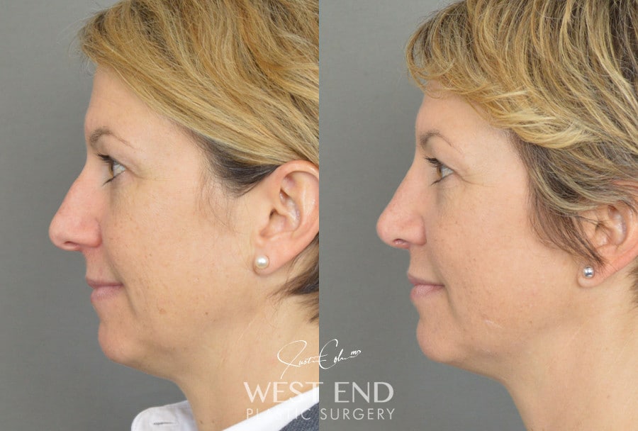 Rhinoplasty before photo. Individual results may vary.