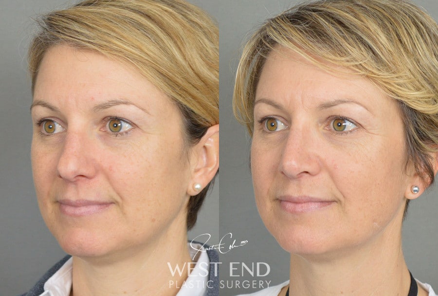 Rhinoplasty before photo. Individual results may vary.