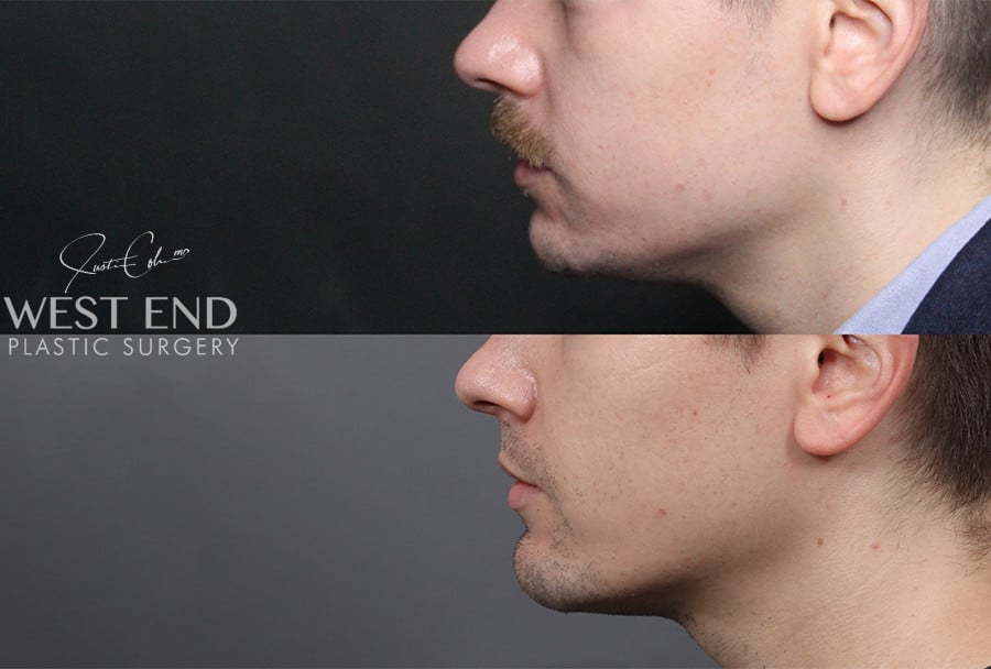 Chin Implant before photo. Individual results may vary.