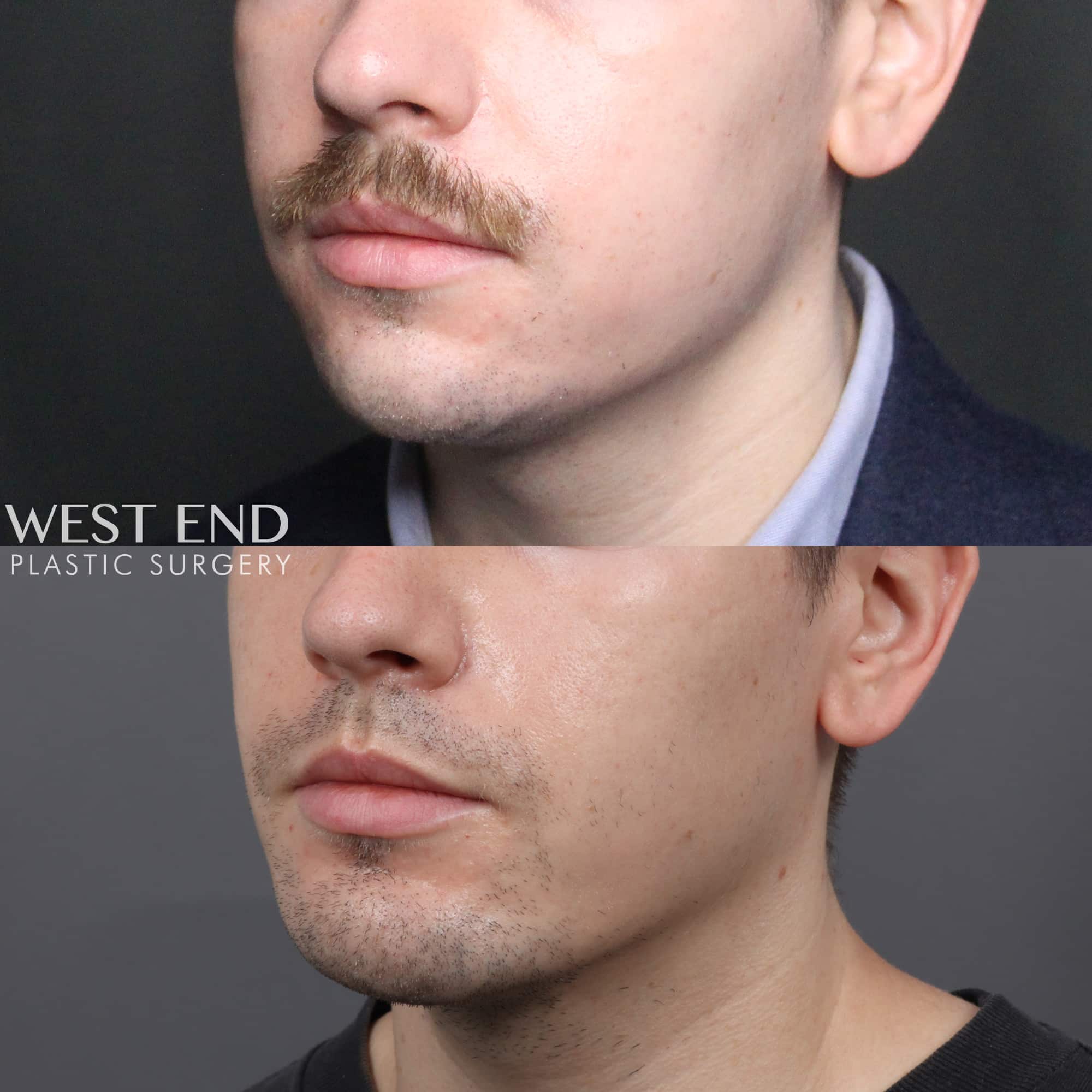 Chin Implant before photo. Individual results may vary.