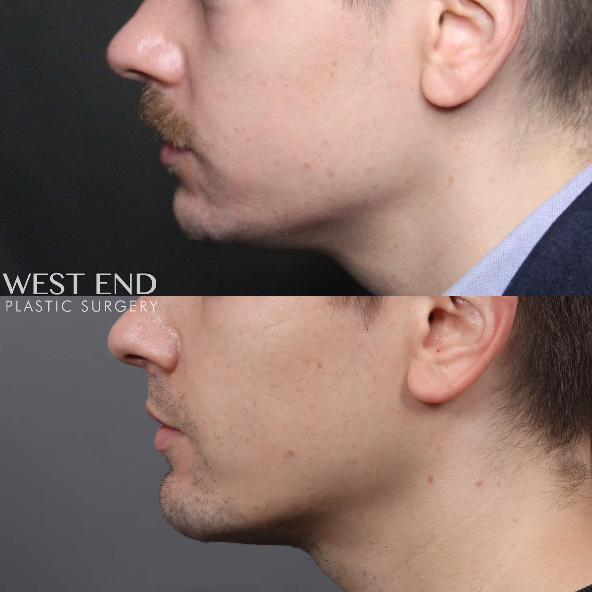 Chin Implant before photo. Individual results may vary.