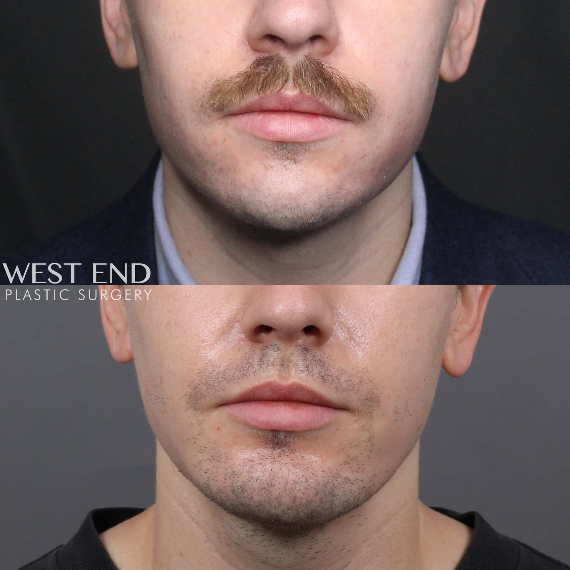 Chin Implant before photo. Individual results may vary.