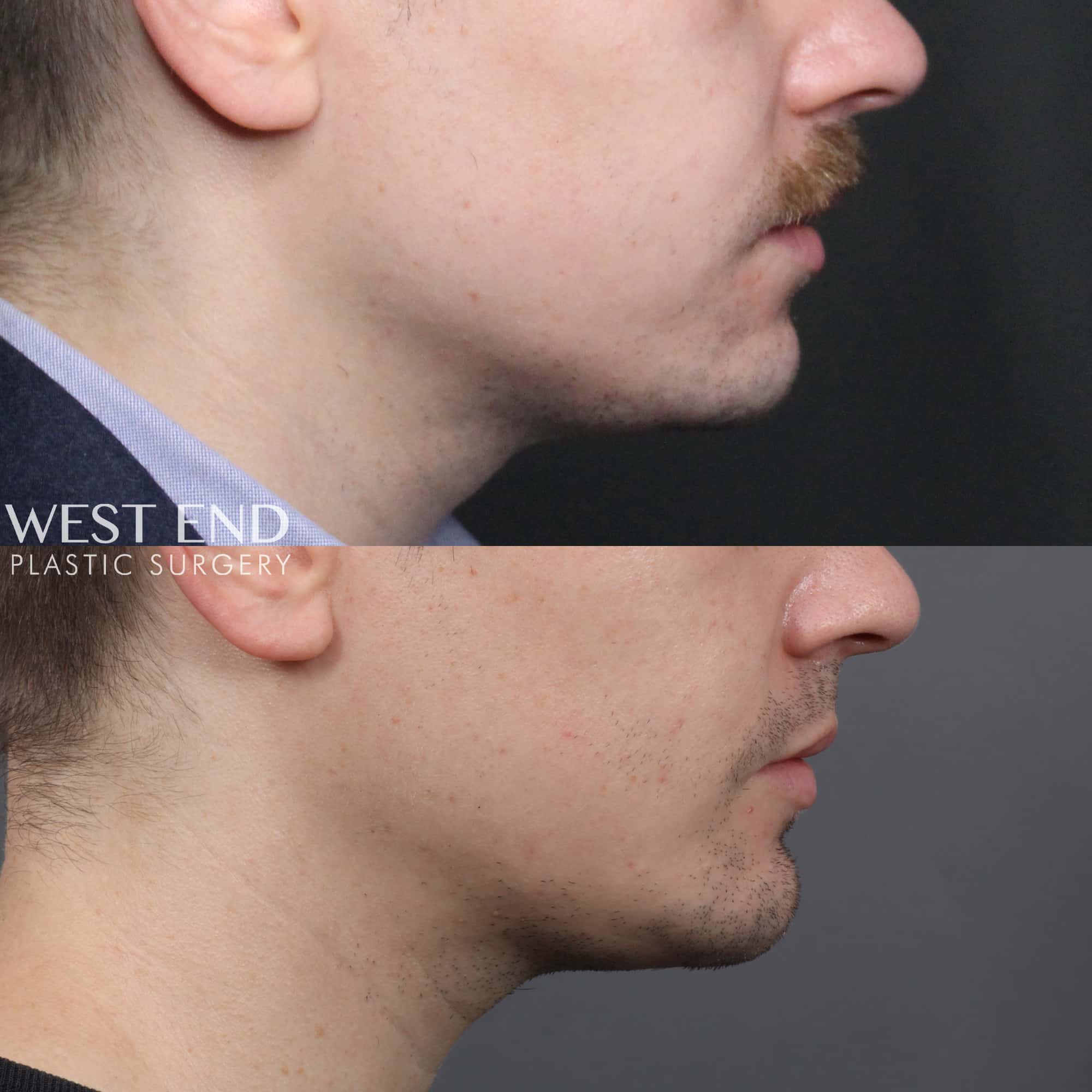 Chin Implant before photo. Individual results may vary.
