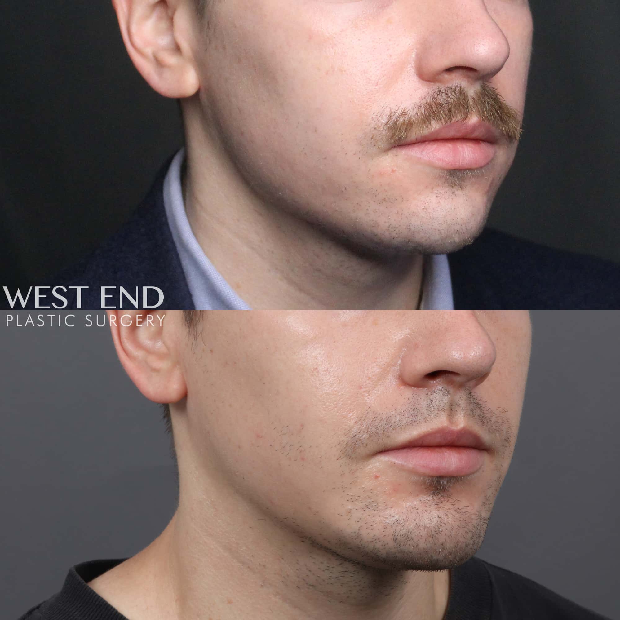 Chin Implant before photo. Individual results may vary.