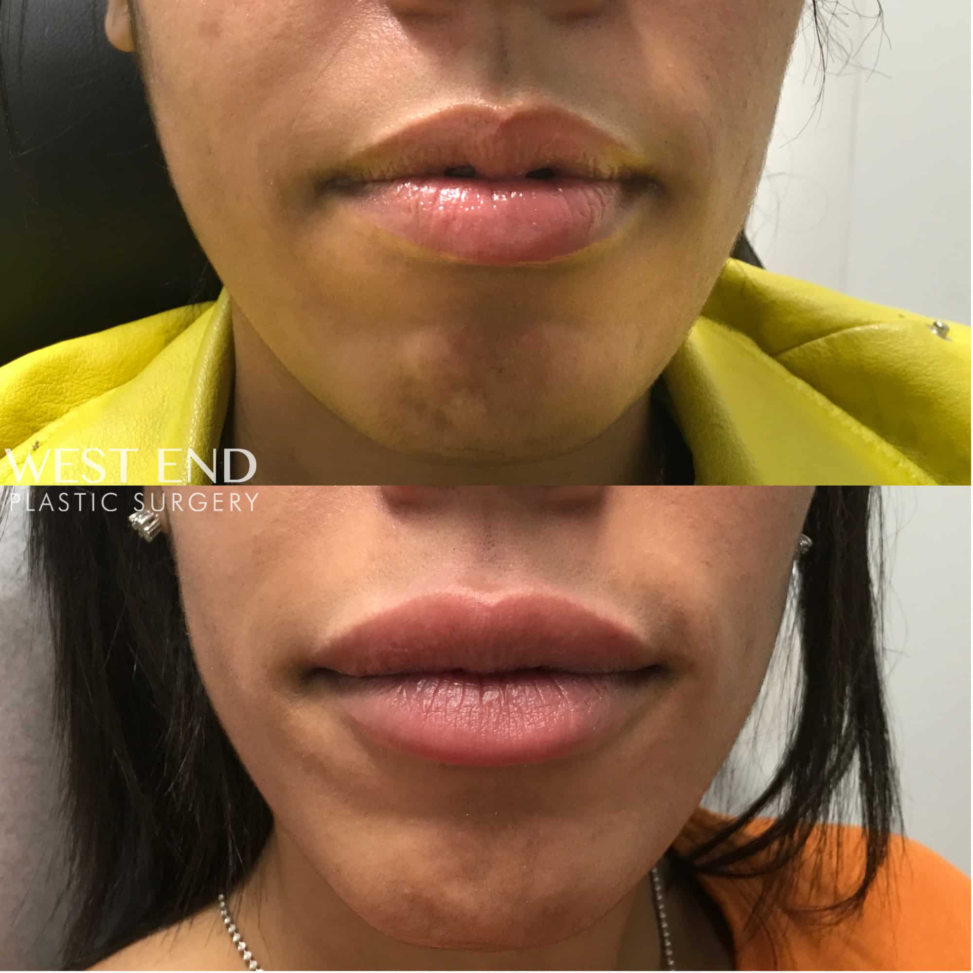 Lip Filler