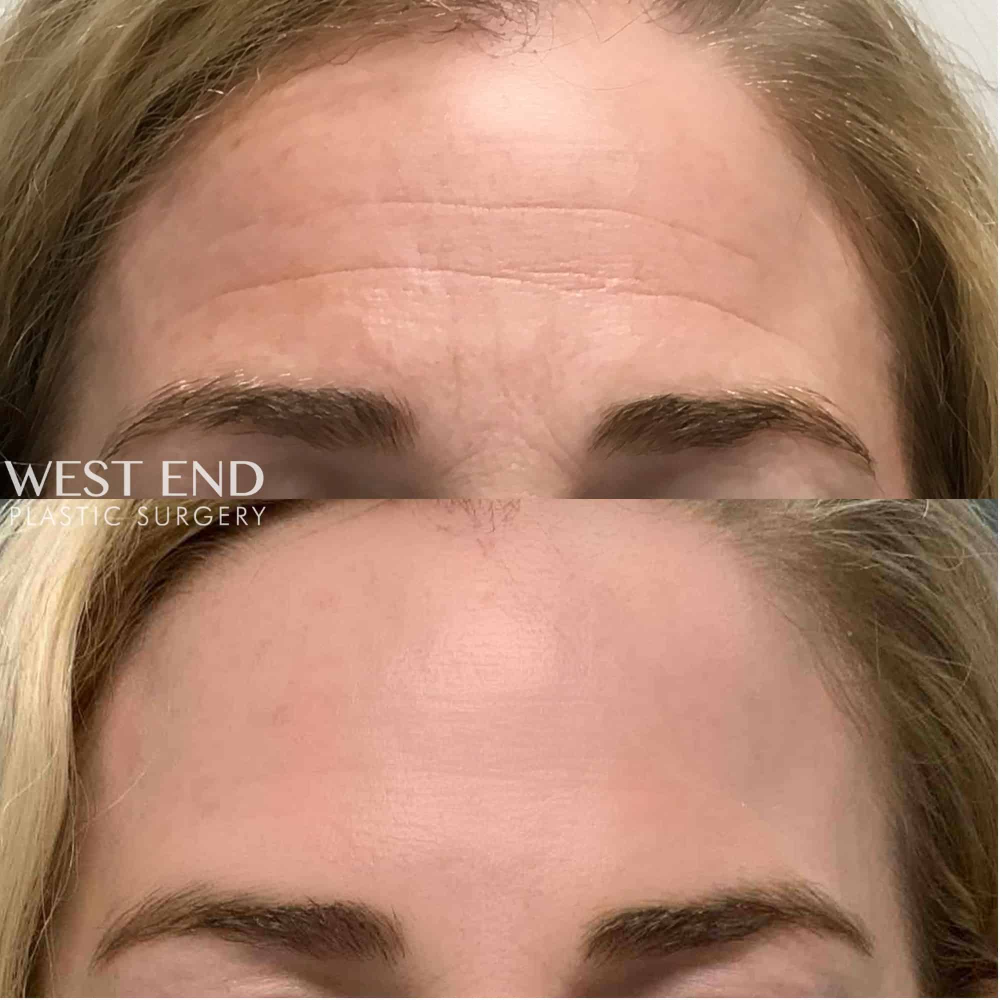Dysport, IPL & Jessner’s Peel