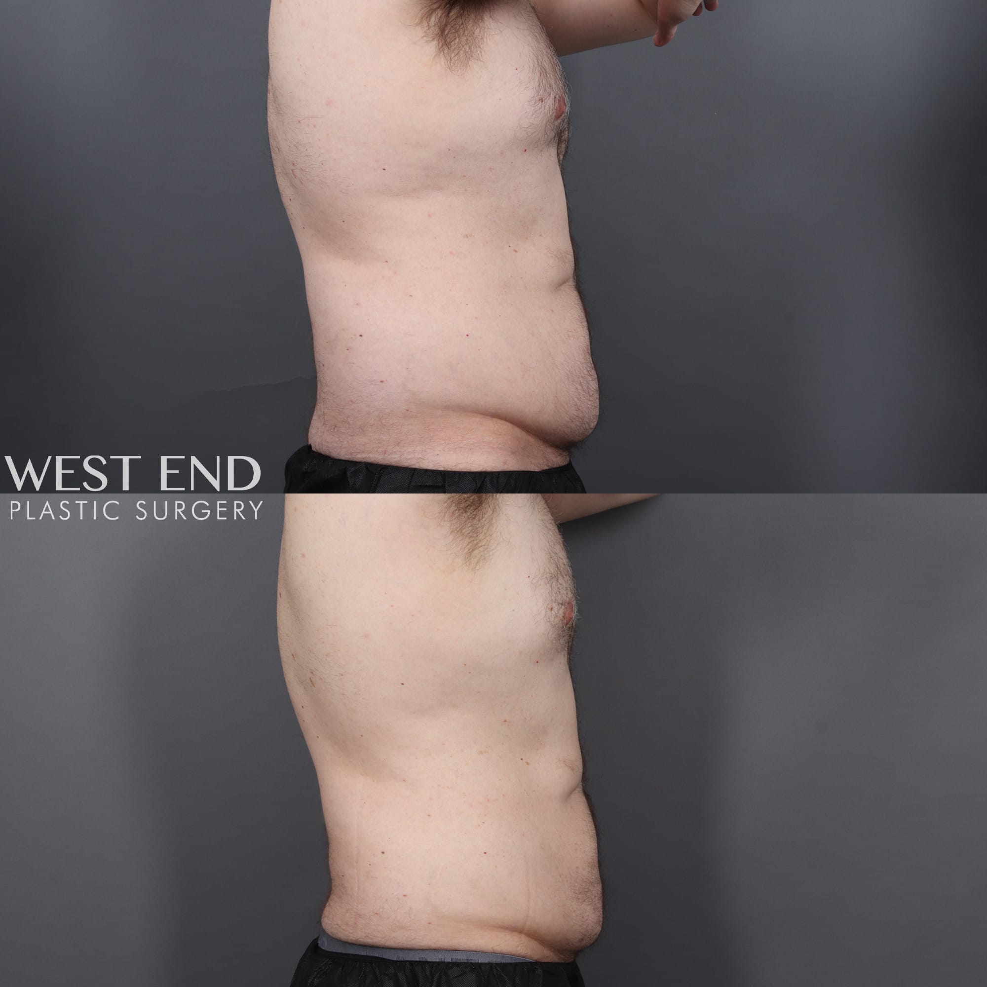 CoolSculpting
