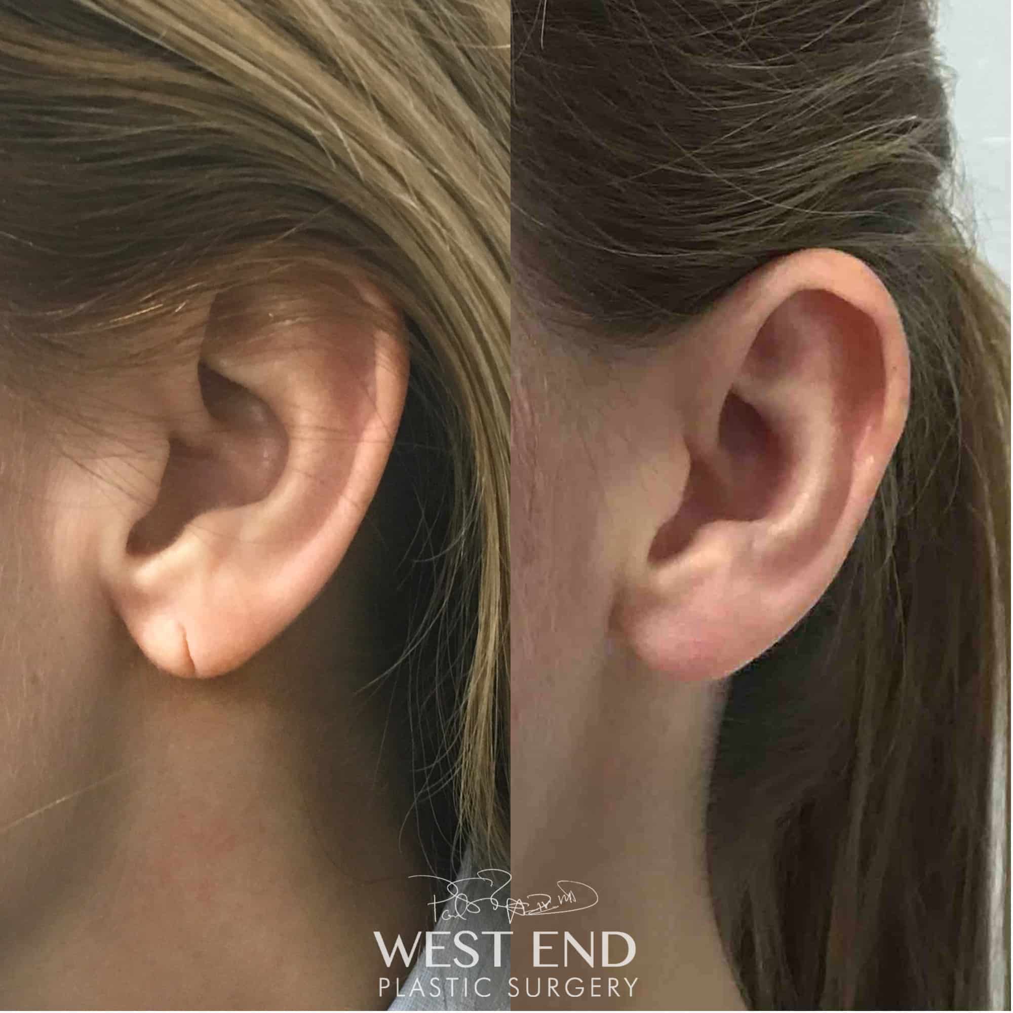 Earlobe Repair