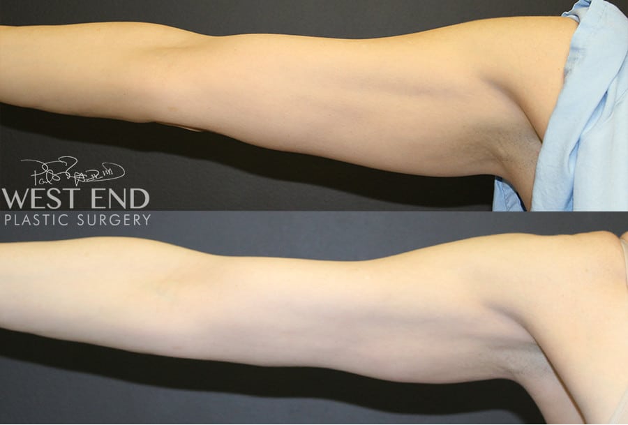 Liposuction