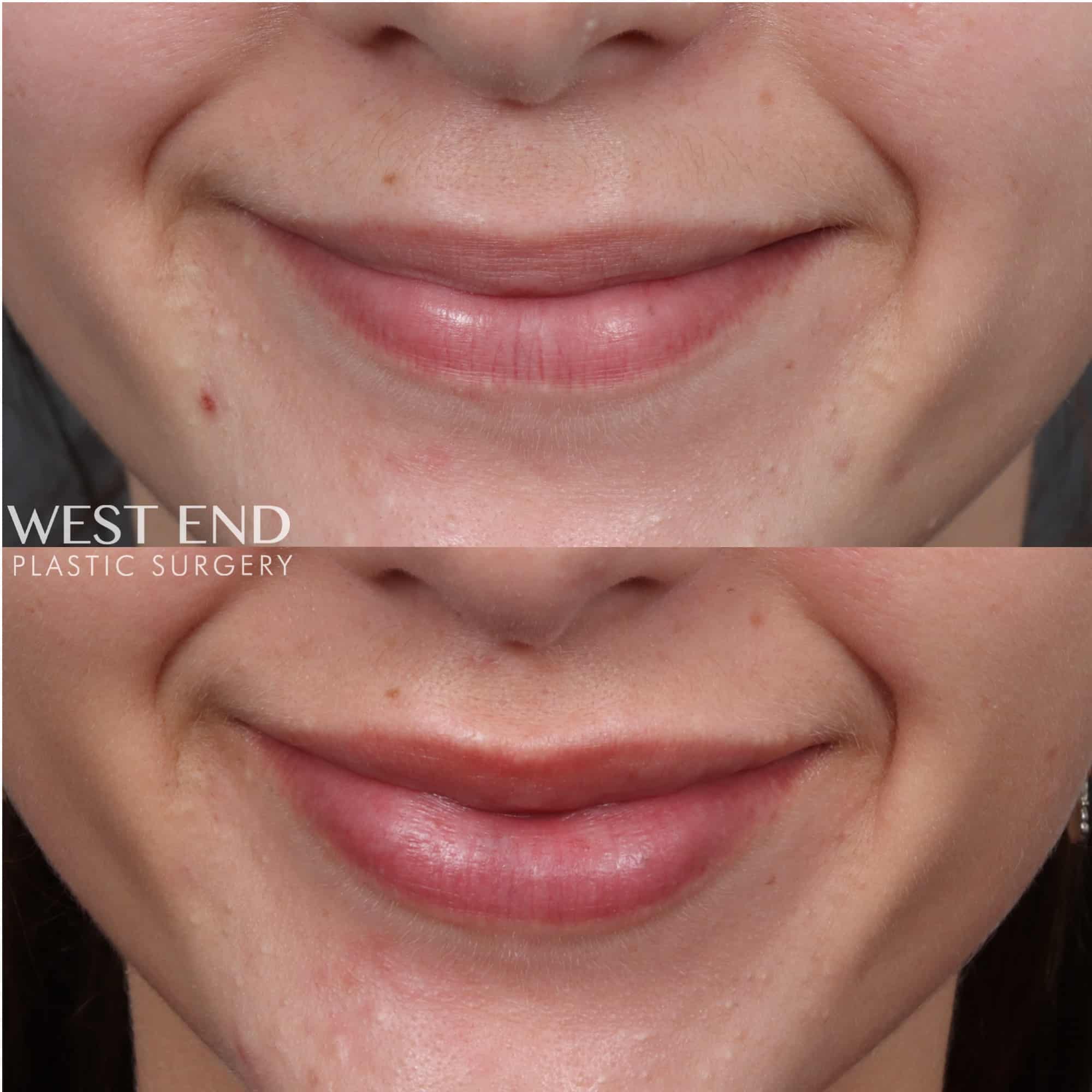 Lip Filler