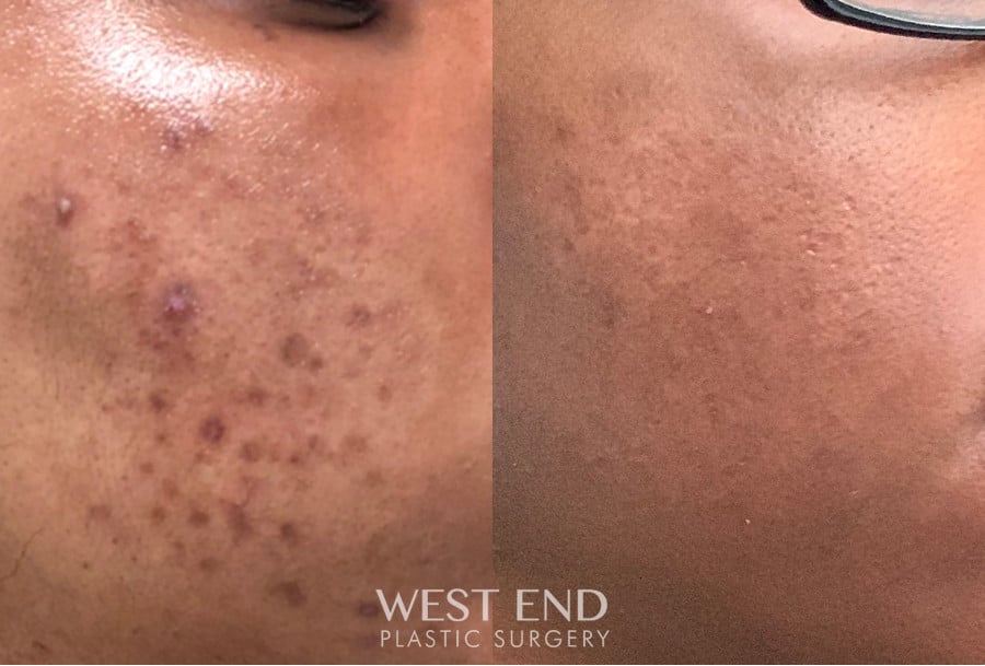 Mini Melanage and Facial + Glycolic Peel