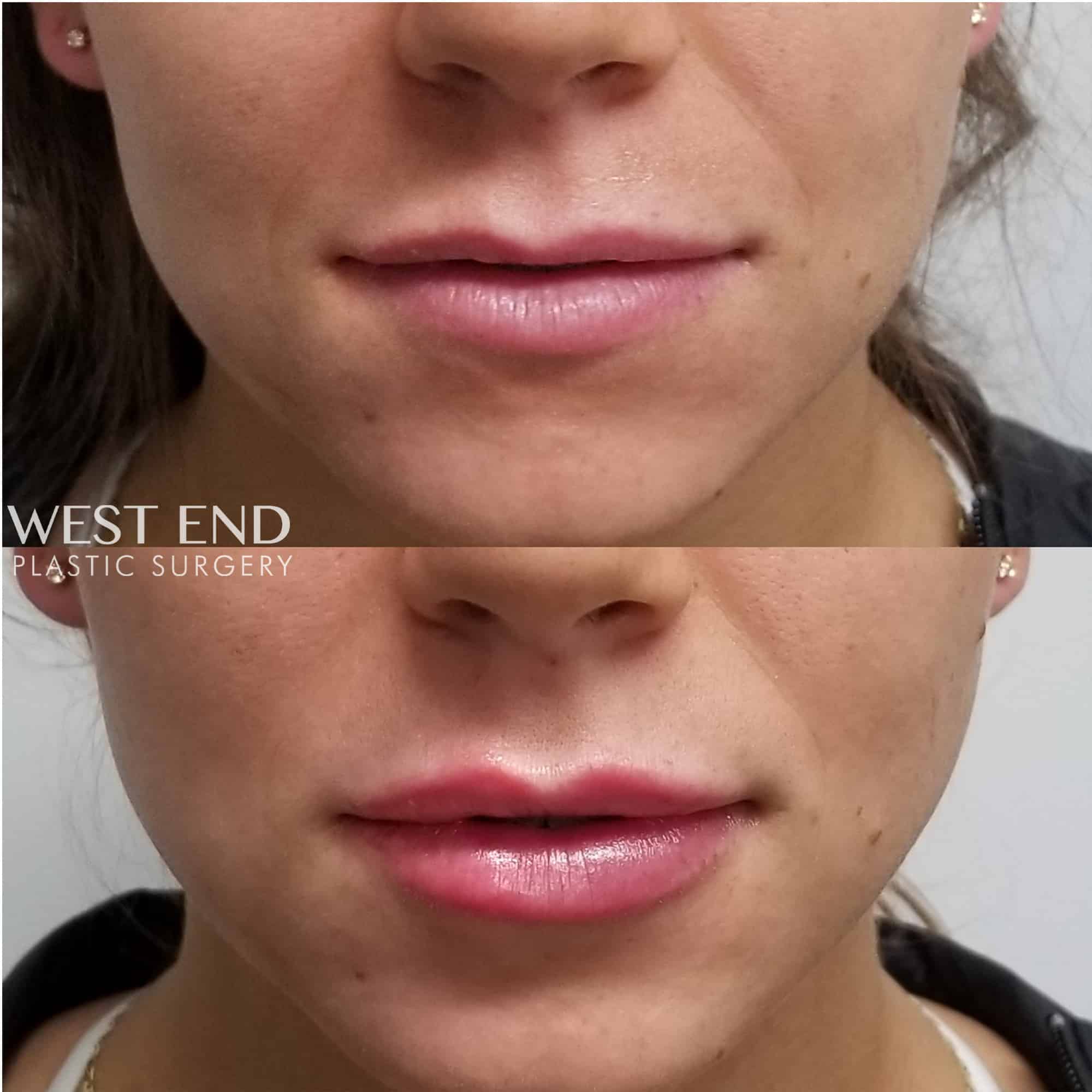 Lip Filler