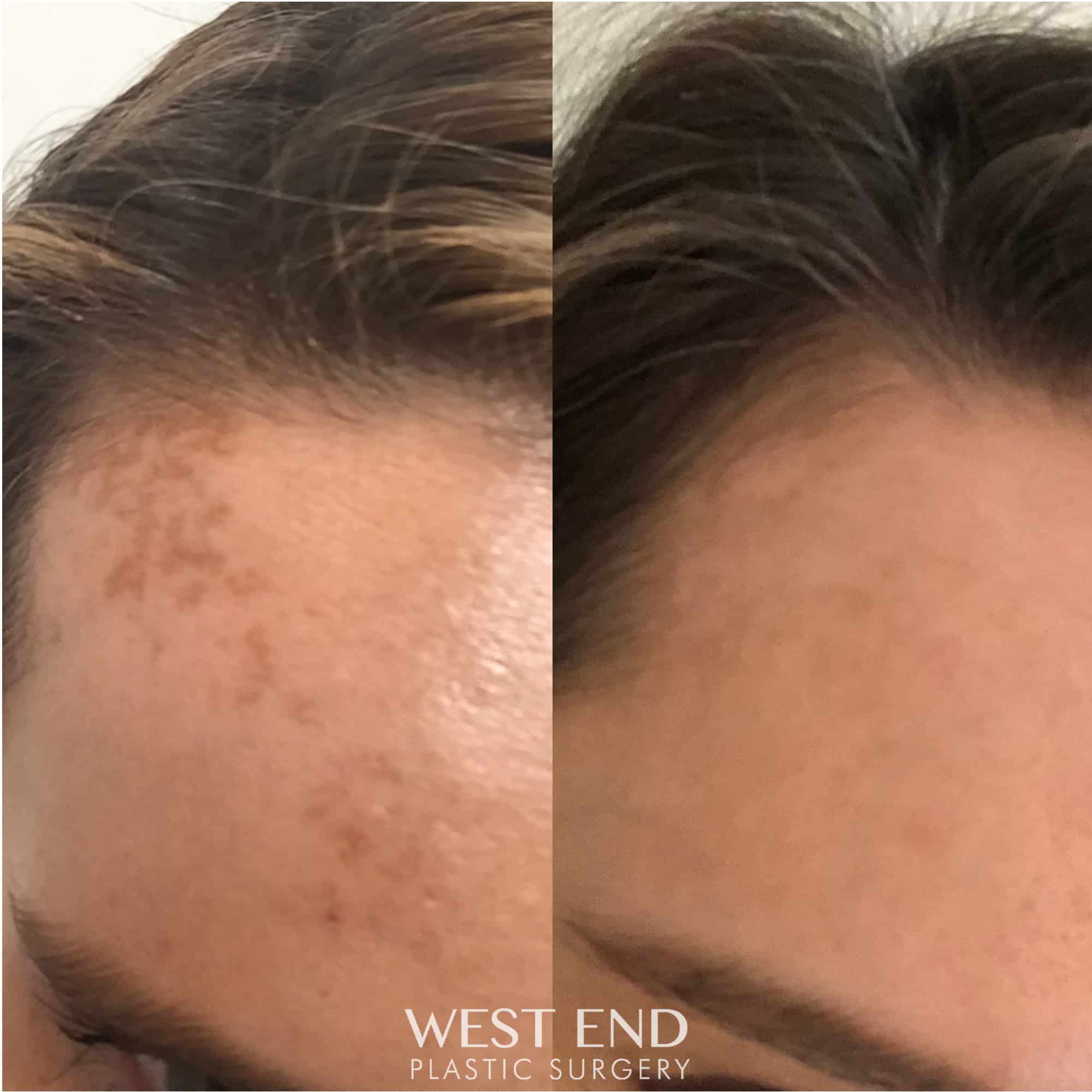 Melasma Treatment with Tetra CO2 CoolPeel and Medical Grade Skincare