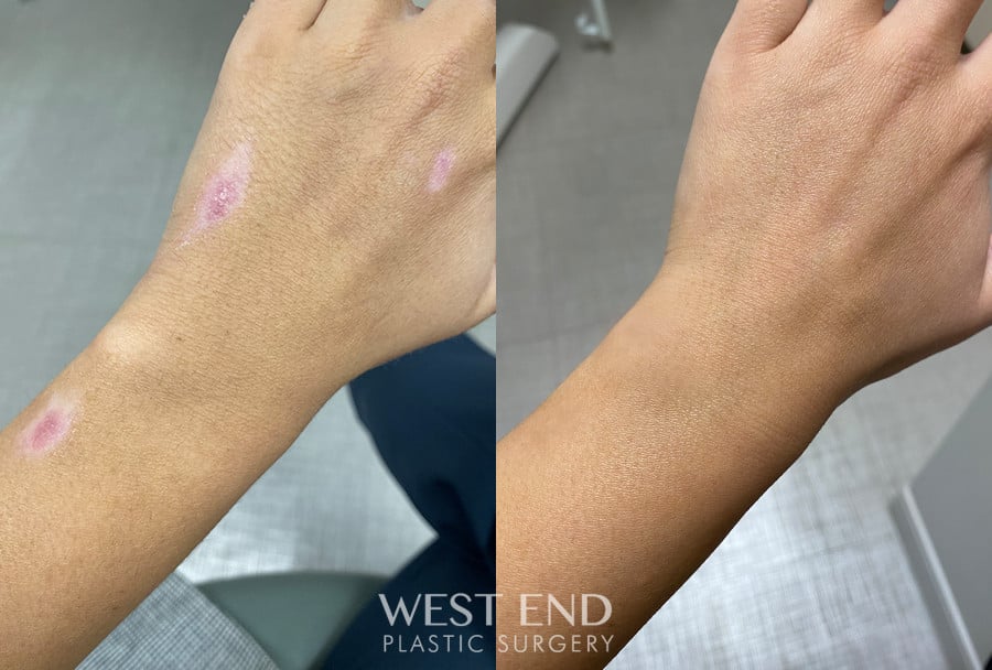 Scar Management with IPL and NewGel+