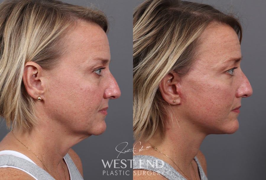 Deep Plane Facelift & Neck Lift before photo. Individual results may vary.