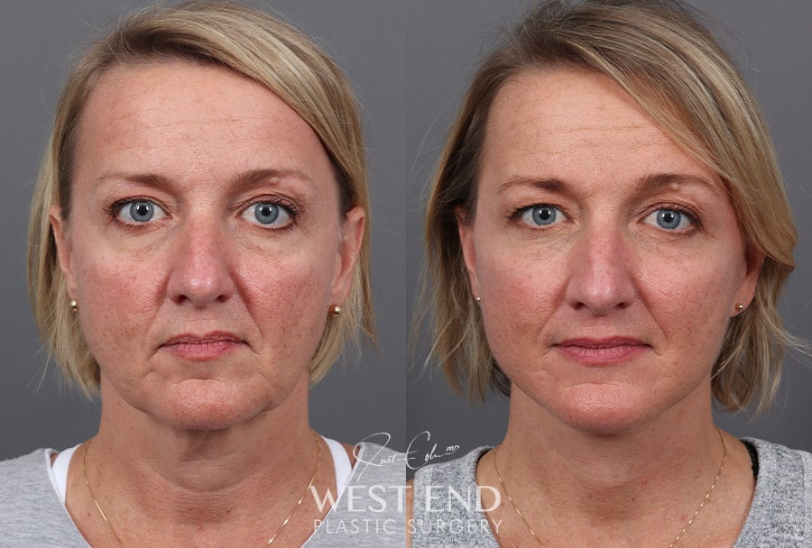 Deep Plane Facelift & Neck Lift before photo. Individual results may vary.