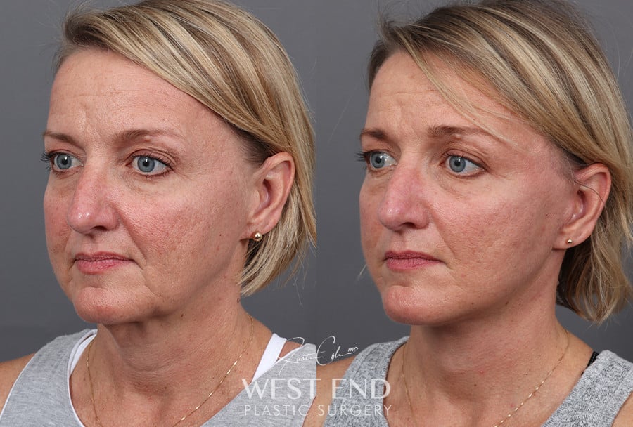 Deep Plane Facelift & Neck Lift before photo. Individual results may vary.