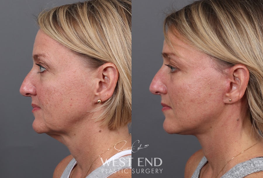 Deep Plane Facelift & Neck Lift before photo. Individual results may vary.