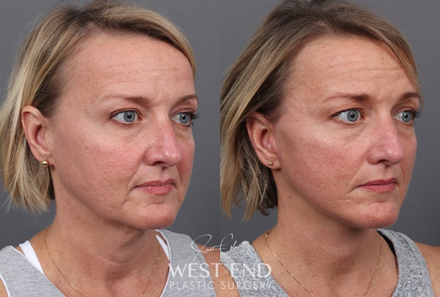 Deep Plane Facelift & Neck Lift before photo. Individual results may vary.