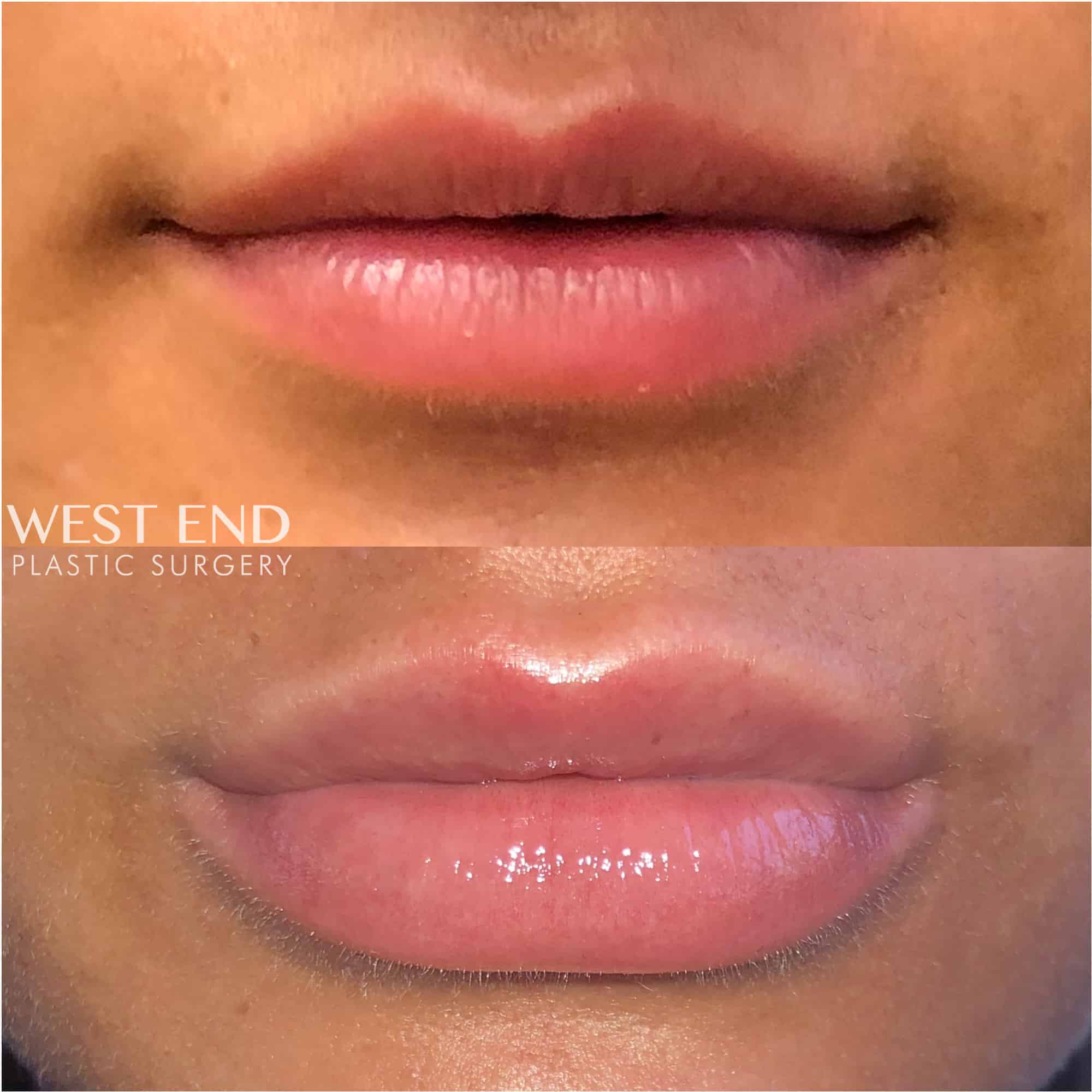 Lip Filler