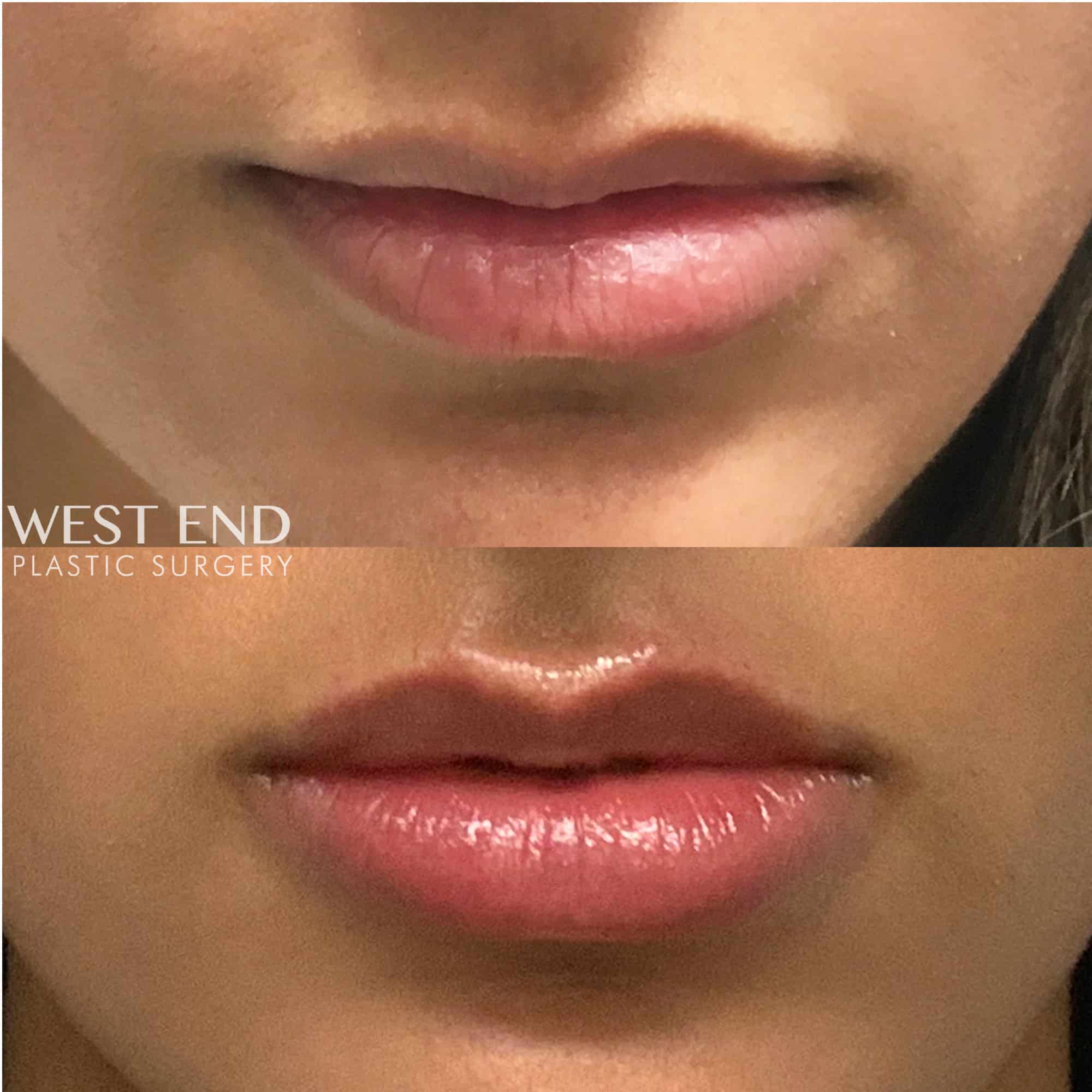 Lip Filler