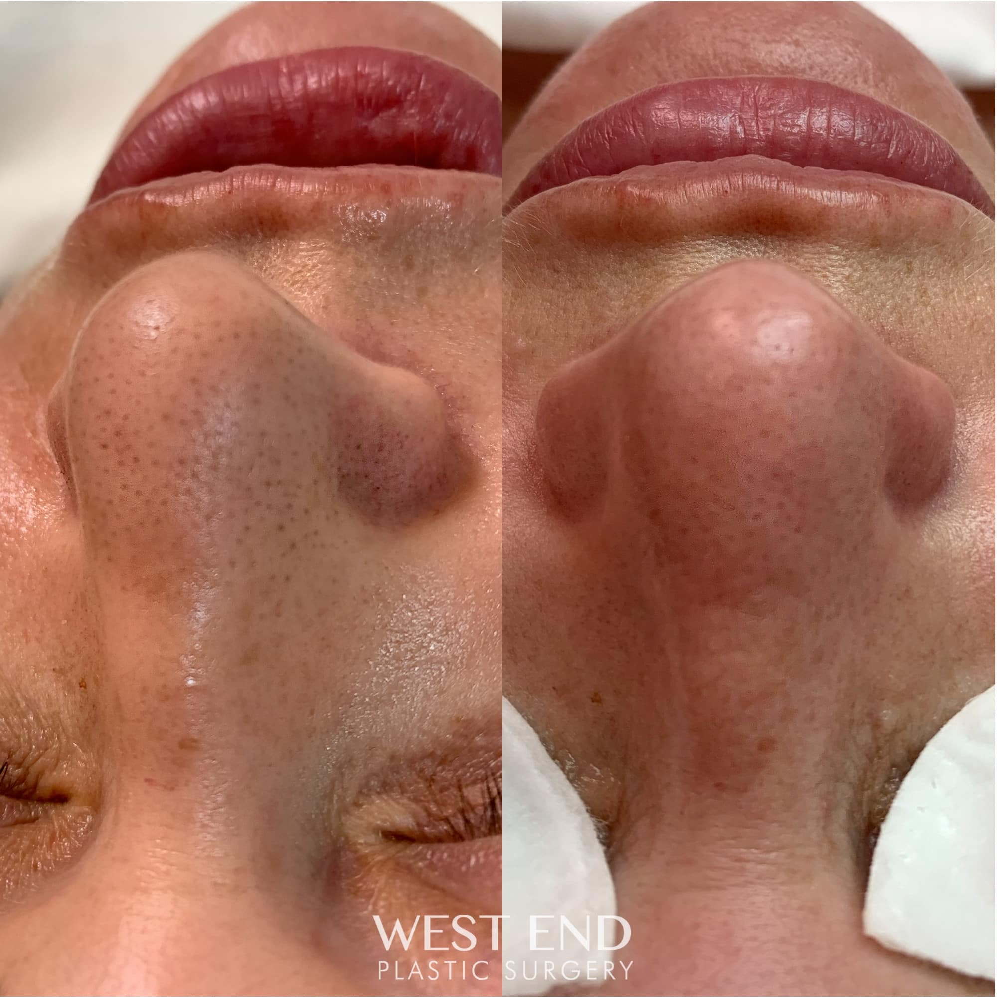 Facial with Extractions