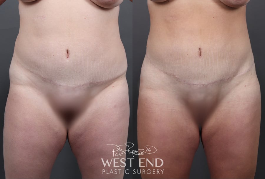 Liposuction and Brazilian Butt Lift