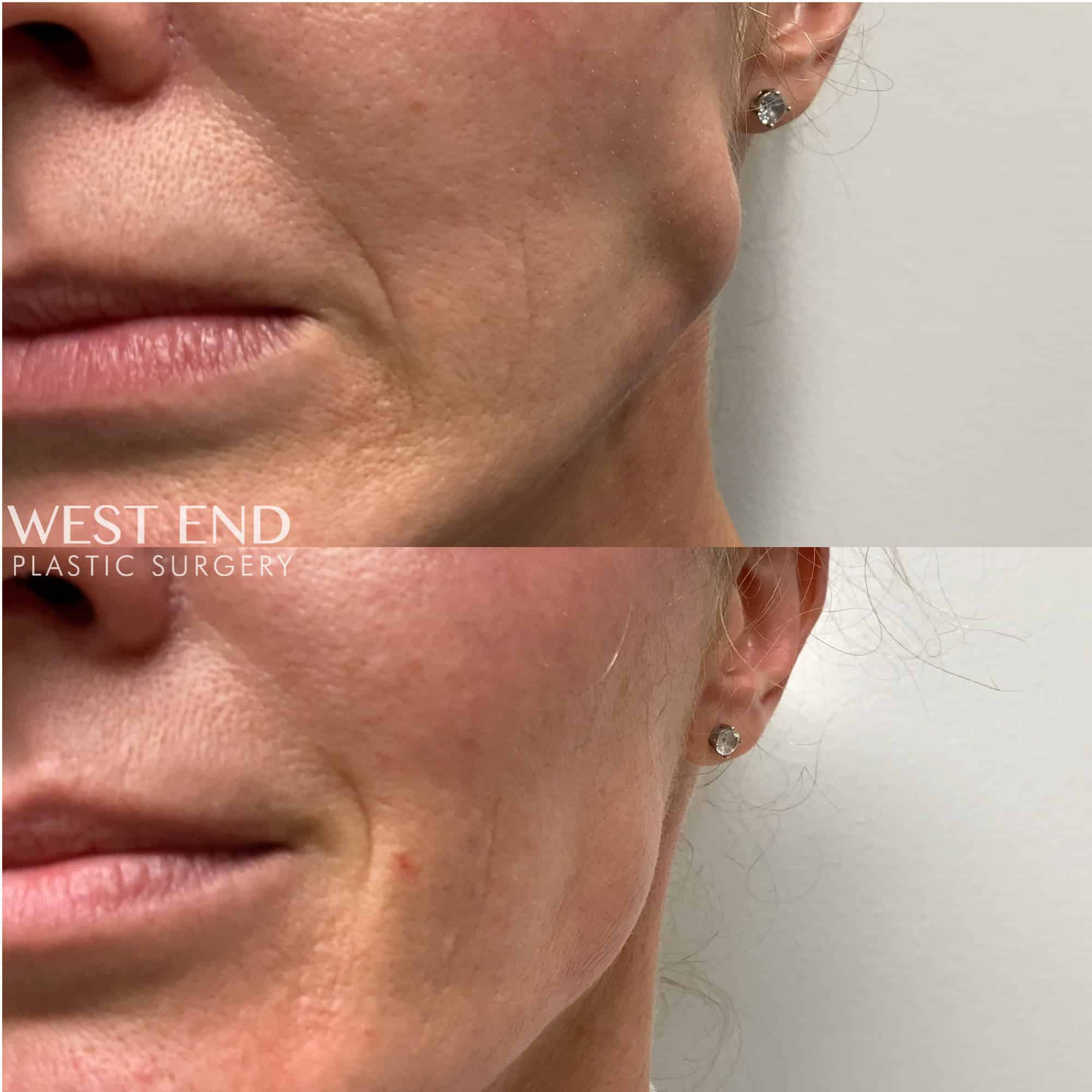 Botox in the Masseter Muscle (Jaw Clenching)