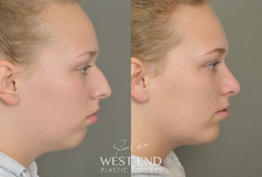 Rhinoplasty & Chin Implant before photo. Individual results may vary.