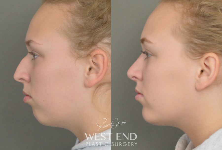 Rhinoplasty & Chin Implant before photo. Individual results may vary.