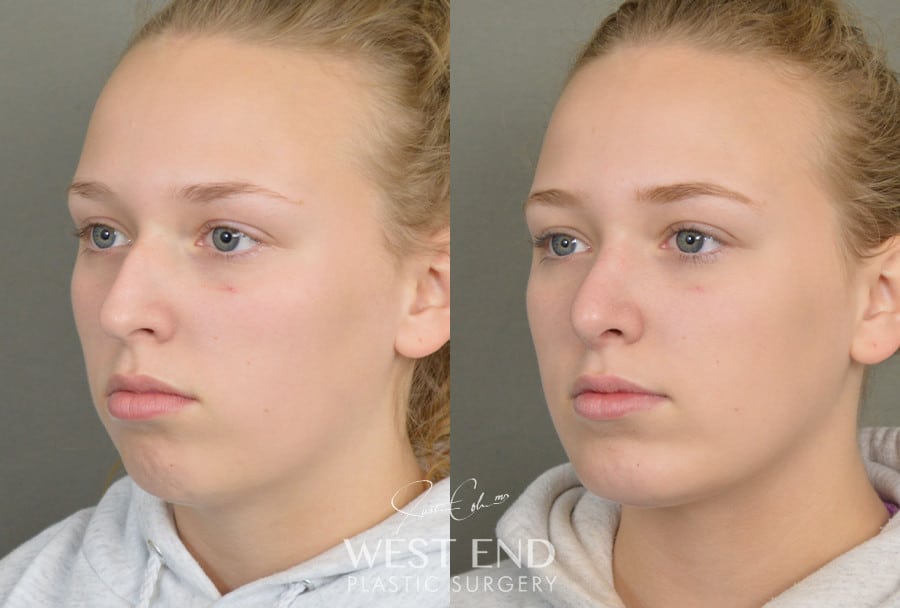 Rhinoplasty & Chin Implant before photo. Individual results may vary.