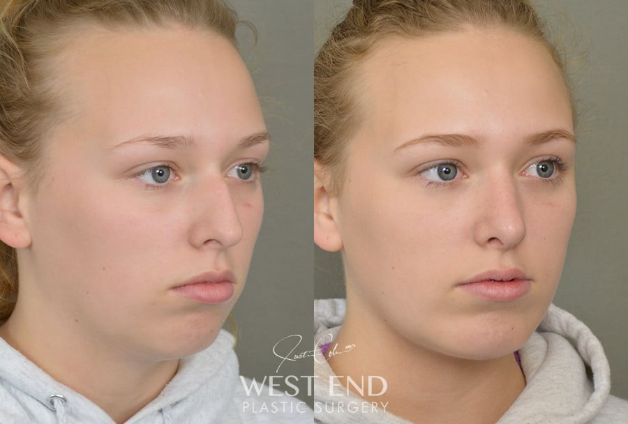 Rhinoplasty & Chin Implant before photo. Individual results may vary.