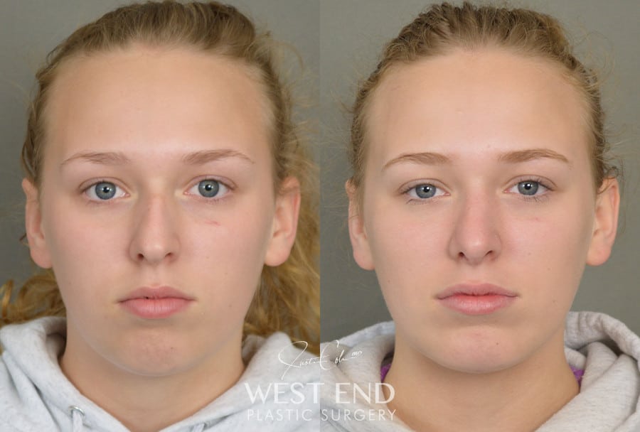 Rhinoplasty & Chin Implant before photo. Individual results may vary.