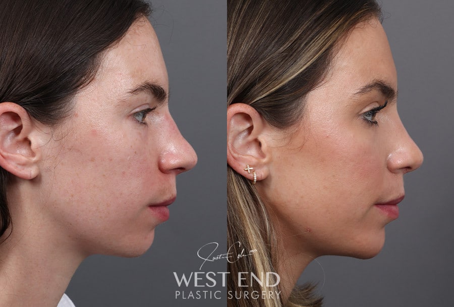 Rhinoplasty & Chin Implant before photo. Individual results may vary.