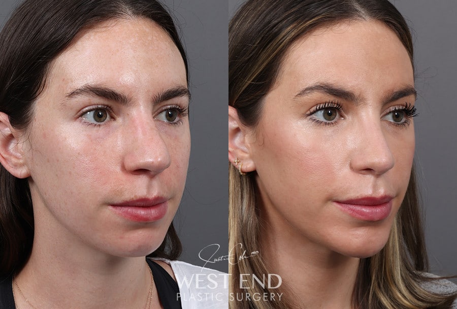 Rhinoplasty & Chin Implant before photo. Individual results may vary.