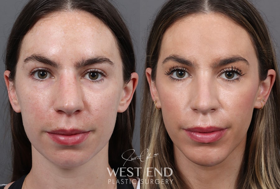 Rhinoplasty & Chin Implant before photo. Individual results may vary.