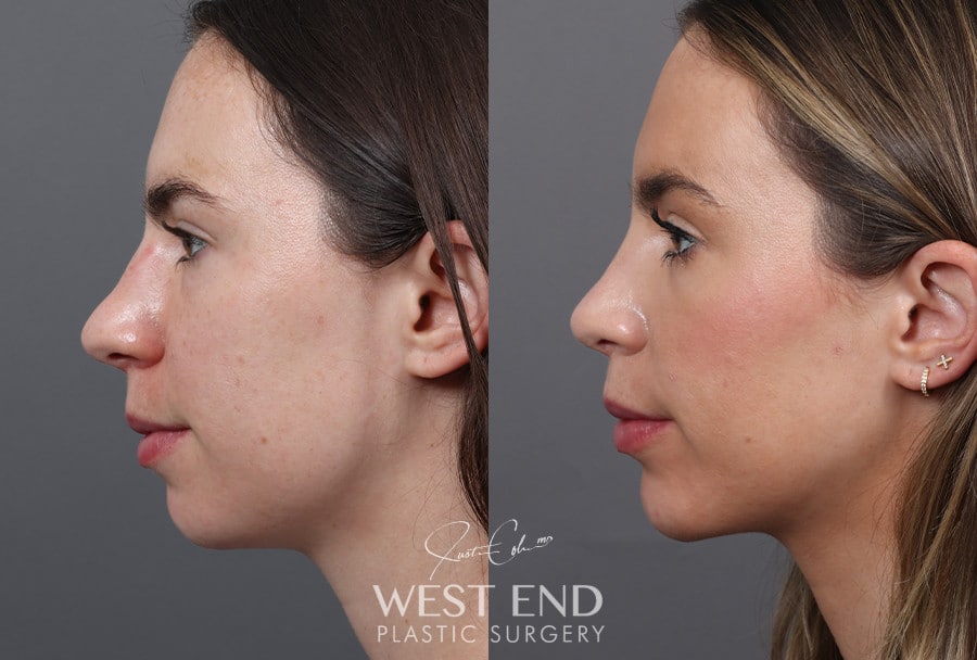 Rhinoplasty & Chin Implant before photo. Individual results may vary.