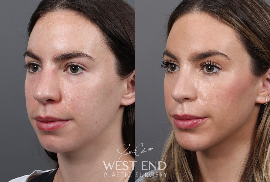Rhinoplasty & Chin Implant before photo. Individual results may vary.