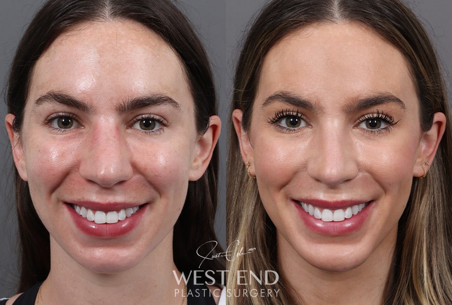 Rhinoplasty & Chin Implant before photo. Individual results may vary.