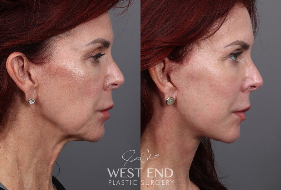Deep Plane Facelift & Neck Lift before photo. Individual results may vary.