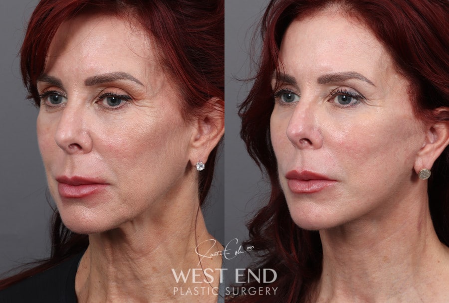 Deep Plane Facelift & Neck Lift before photo. Individual results may vary.