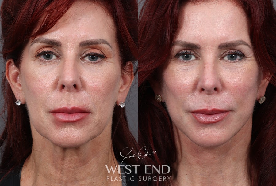 Deep Plane Facelift & Neck Lift before photo. Individual results may vary.