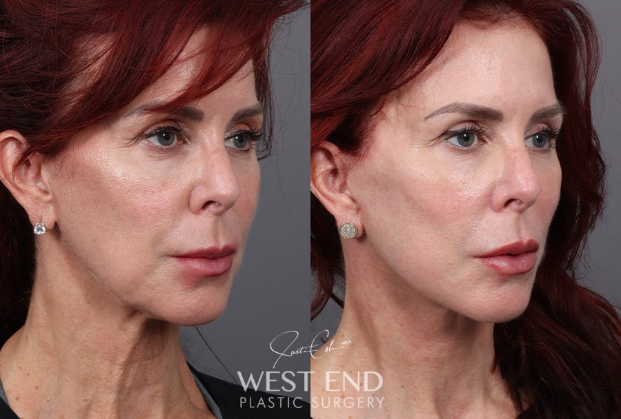 Deep Plane Facelift & Neck Lift before photo. Individual results may vary.