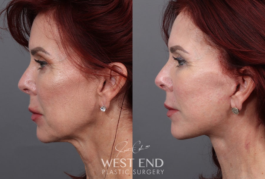Deep Plane Facelift & Neck Lift before photo. Individual results may vary.