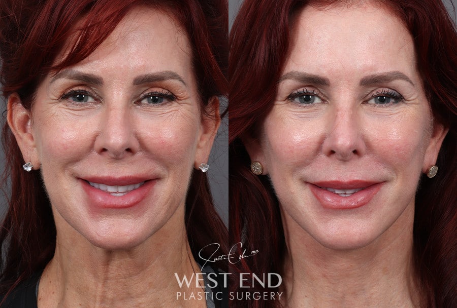 Deep Plane Facelift & Neck Lift before photo. Individual results may vary.