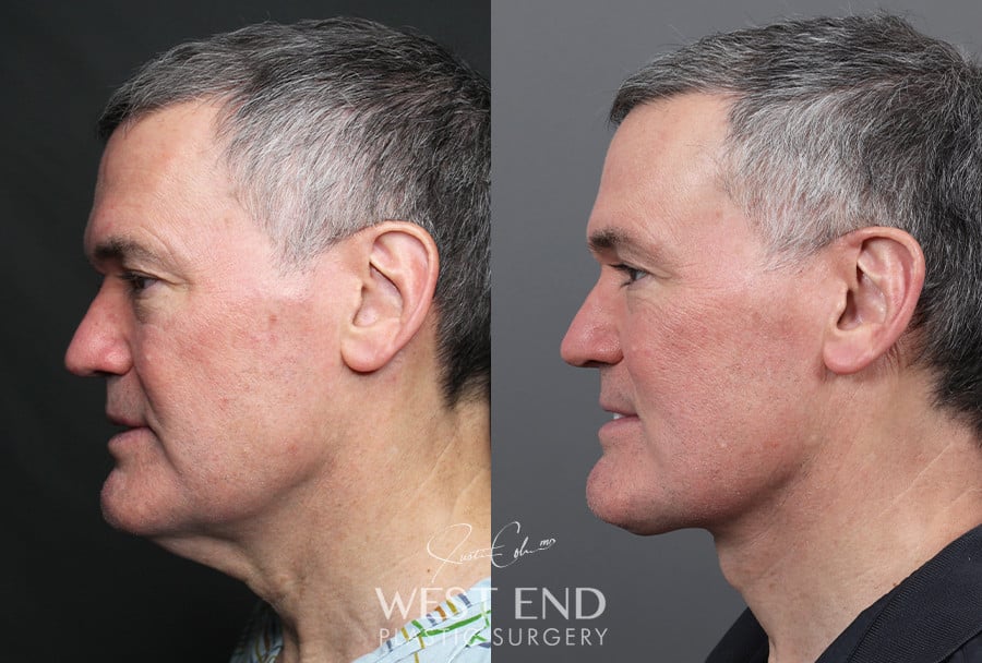 Neck Lift before photo. Individual results may vary.